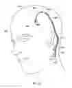 Fig. 23 - Methods of shielding implantable medical leads and implantable medical lead extensions