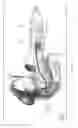 Fig. 04 - Interventional drug delivery system and associated methods