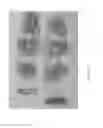 Fig. 27 - Interventional drug delivery system and associated methods