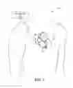 Fig. 02 - Atrial contraction detection by a ventricular leadless pacing device for atrio-synchronous ventricular pacing