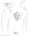 Fig. 04 - Atrial contraction detection by a ventricular leadless pacing device for atrio-synchronous ventricular pacing