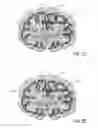 Fig. 08 - TRANSCRANIAL MAGNETIC STIMULATION FIELD SHAPING