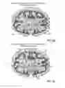 Fig. 13 - TRANSCRANIAL MAGNETIC STIMULATION FIELD SHAPING