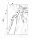 Fig. 04 - Window wiper system for providing enhanced performance in winter weather conditions