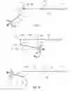Fig. 04 - Method and device for determining an operational distance of an unspecified termination segment of an aircraft flight plan