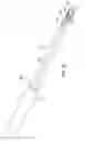 Fig. 02 - Chronic total occlusion crossing devices with imaging