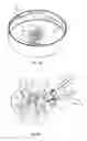 Fig. 03 - Fluid extraction and drug delivery system and methods using microneedles