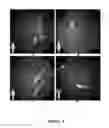 Fig. 02 - FUNCTIONAL NEAR-INFRARED FLUORESCENCE LYMPHATIC MAPPING FOR DIAGNOSING, ACCESSING, MONITORING AND DIRECTING THERAPY OF LYMPHATIC DISORDERS