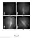 Fig. 03 - FUNCTIONAL NEAR-INFRARED FLUORESCENCE LYMPHATIC MAPPING FOR DIAGNOSING, ACCESSING, MONITORING AND DIRECTING THERAPY OF LYMPHATIC DISORDERS