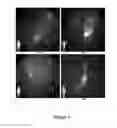 Fig. 04 - FUNCTIONAL NEAR-INFRARED FLUORESCENCE LYMPHATIC MAPPING FOR DIAGNOSING, ACCESSING, MONITORING AND DIRECTING THERAPY OF LYMPHATIC DISORDERS