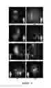 Fig. 05 - FUNCTIONAL NEAR-INFRARED FLUORESCENCE LYMPHATIC MAPPING FOR DIAGNOSING, ACCESSING, MONITORING AND DIRECTING THERAPY OF LYMPHATIC DISORDERS