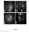 Fig. 07 - FUNCTIONAL NEAR-INFRARED FLUORESCENCE LYMPHATIC MAPPING FOR DIAGNOSING, ACCESSING, MONITORING AND DIRECTING THERAPY OF LYMPHATIC DISORDERS