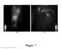Fig. 08 - FUNCTIONAL NEAR-INFRARED FLUORESCENCE LYMPHATIC MAPPING FOR DIAGNOSING, ACCESSING, MONITORING AND DIRECTING THERAPY OF LYMPHATIC DISORDERS
