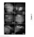 Fig. 10 - FUNCTIONAL NEAR-INFRARED FLUORESCENCE LYMPHATIC MAPPING FOR DIAGNOSING, ACCESSING, MONITORING AND DIRECTING THERAPY OF LYMPHATIC DISORDERS