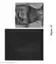Fig. 16 - FUNCTIONAL NEAR-INFRARED FLUORESCENCE LYMPHATIC MAPPING FOR DIAGNOSING, ACCESSING, MONITORING AND DIRECTING THERAPY OF LYMPHATIC DISORDERS