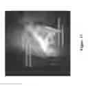 Fig. 18 - FUNCTIONAL NEAR-INFRARED FLUORESCENCE LYMPHATIC MAPPING FOR DIAGNOSING, ACCESSING, MONITORING AND DIRECTING THERAPY OF LYMPHATIC DISORDERS