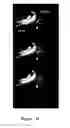 Fig. 19 - FUNCTIONAL NEAR-INFRARED FLUORESCENCE LYMPHATIC MAPPING FOR DIAGNOSING, ACCESSING, MONITORING AND DIRECTING THERAPY OF LYMPHATIC DISORDERS