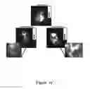 Fig. 22 - FUNCTIONAL NEAR-INFRARED FLUORESCENCE LYMPHATIC MAPPING FOR DIAGNOSING, ACCESSING, MONITORING AND DIRECTING THERAPY OF LYMPHATIC DISORDERS