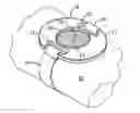 Fig. 01 - Sweat collecting device