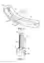 Fig. 03 - Adjustable orthopaedic joint distractor