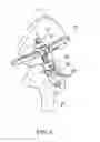 Fig. 05 - Adjustable orthopaedic joint distractor