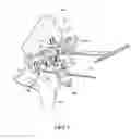 Fig. 06 - Adjustable orthopaedic joint distractor