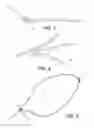 Fig. 03 - Adjustable suture-button construct for ankle syndesmosis repair