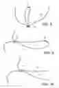 Fig. 05 - Adjustable suture-button construct for ankle syndesmosis repair