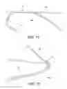Fig. 06 - Adjustable suture-button construct for ankle syndesmosis repair