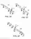 Fig. 13 - Adjustable suture-button construct for ankle syndesmosis repair