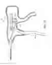 Fig. 14 - Suture assembly including a suture clip