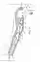 Fig. 18 - Suture assembly including a suture clip
