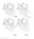 Fig. 30 - Embolisation systems