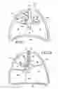 Fig. 02 - REMOVABLE LUNG REDUCTION DEVICES, SYSTEMS, AND METHODS