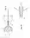 Fig. 17 - Endovascular occlusion device with hemodynamically enhanced sealing and anchoring