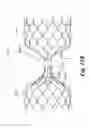 Fig. 41 - Endovascular occlusion device with hemodynamically enhanced sealing and anchoring