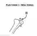 Fig. 01 - Systems and methods for pre-operative planning and precise bone tunnel placement for ligament reconstruction