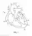 Fig. 02 - SYSTEM AND METHOD FOR TRANSAPICAL ACCESS AND CLOSURE