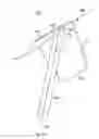 Fig. 08 - Externally applied intrapartum support device