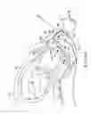 Fig. 19 - Externally applied intrapartum support device