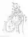 Fig. 20 - Externally applied intrapartum support device