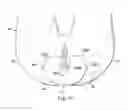 Fig. 37 - Externally applied intrapartum support device