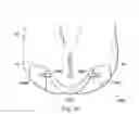 Fig. 45 - Externally applied intrapartum support device