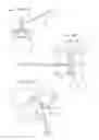 Fig. 07 - Systems and methods for posterior dynamic stabilization of the spine