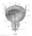 Fig. 04 - BLADDER TREATMENT BY ABLATIVE DENERVATION