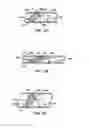 Fig. 03 - ENDOLUMINAL FILTER HAVING ENHANCED ECHOGENIC PROPERTIES