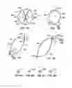 Fig. 07 - ENDOLUMINAL FILTER HAVING ENHANCED ECHOGENIC PROPERTIES
