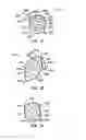 Fig. 15 - ENDOLUMINAL FILTER HAVING ENHANCED ECHOGENIC PROPERTIES