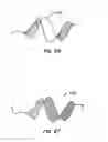 Fig. 36 - ENDOLUMINAL FILTER HAVING ENHANCED ECHOGENIC PROPERTIES
