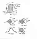 Fig. 52 - ENDOLUMINAL FILTER HAVING ENHANCED ECHOGENIC PROPERTIES